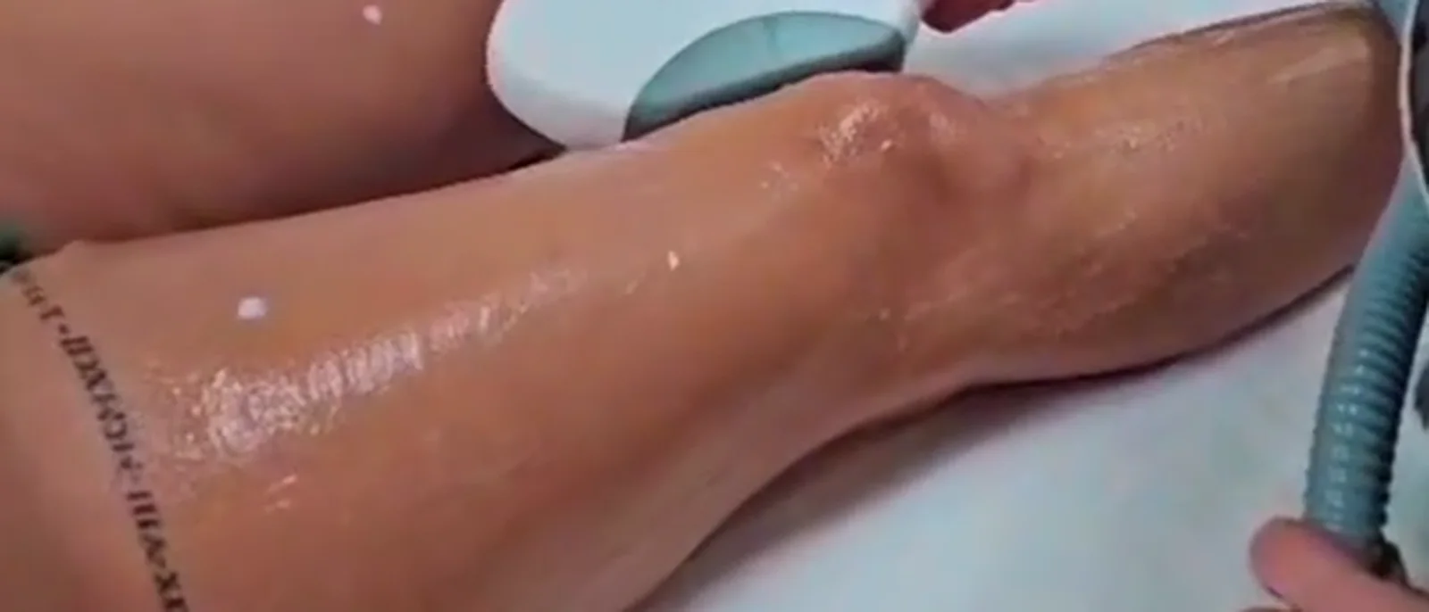 Ședință de epilare definitivă cu laser pe picior, la SCP Shine & Style