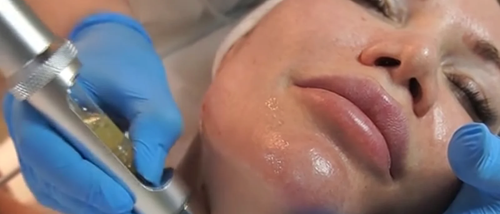 Ședință de mezoterapie facială la SCP Shine & Style