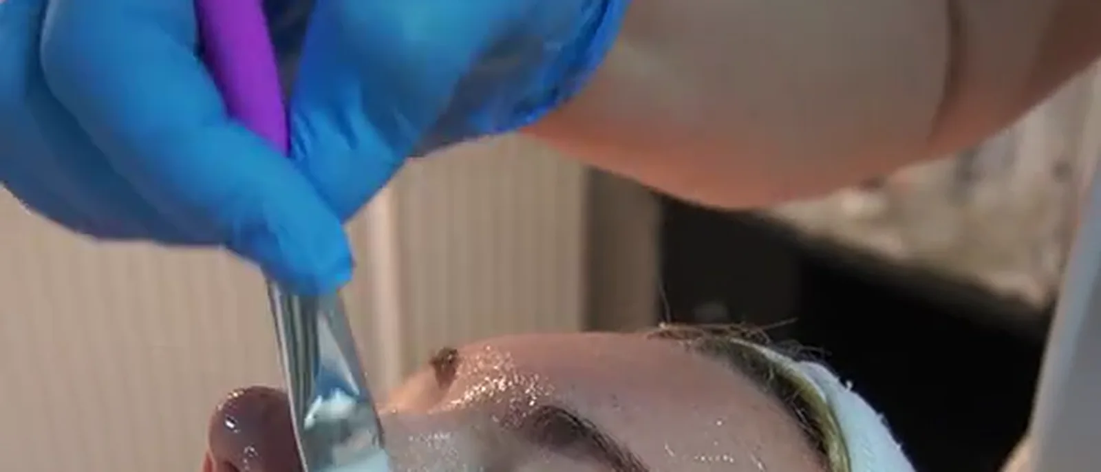 Microdermabraziune aplicată pe frunte, în cabinetul de cosmetică